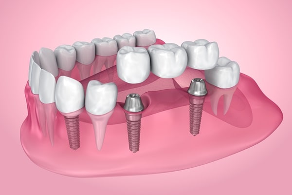 all-on-4-dental-implants-360-dental-specialists