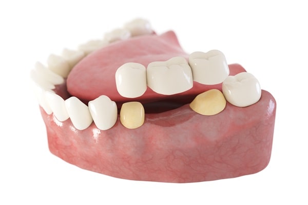 dental-bridges-360-dental-specialists