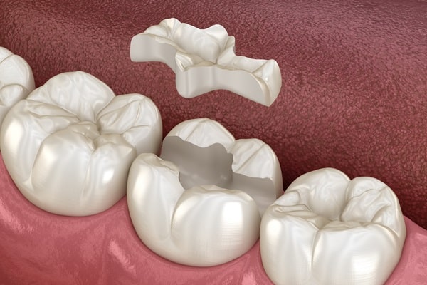 inlays-and-onlays-360-dental-specialists